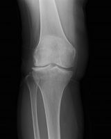 変形性膝関節症｜外側円板状半月板損傷