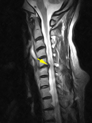 頚椎椎間板ヘルニアのMRI