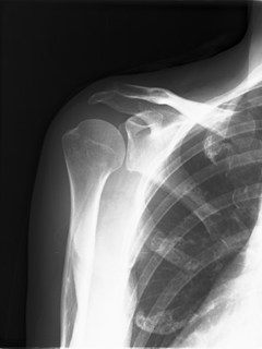 肩関節のレントゲンでは異常なしといわれることがほとんど