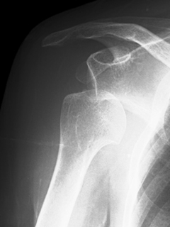肩関節不安定症（ルーズショルダー） レントゲン画像