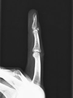 突き指で第一関節が伸ばせない場合，伸筋腱断裂または末節骨剥離骨折が疑われます！