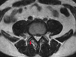 椎間関節症のMRI画像（腰椎横断像）