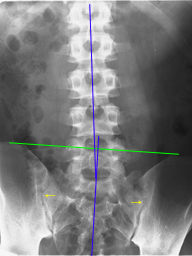 左側仙腸関節（黄色の矢印）がずれて痛みを出しています