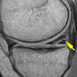 半月板損傷のMRI画像．MRIの半月板損傷の診断精度は95%，靱帯損傷で65-85%といわれています．