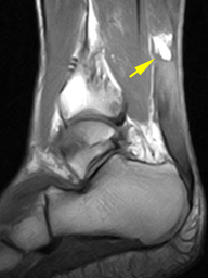 アキレス腱断裂のMRI画像