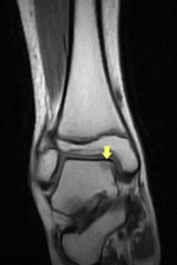 足関節捻挫でもMRI検査をすると離断性骨軟骨炎になっていることがあります